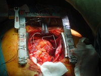 Kalp Nakli Nasıl Yapılır?